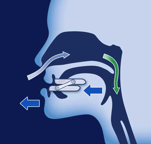 Stop snoring: Oniris anti-snoring solution